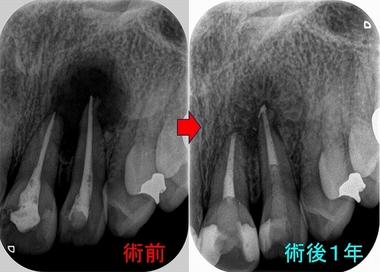 間違った根管治療で大きな根尖病変（膿） - EE DENTAL_Blog